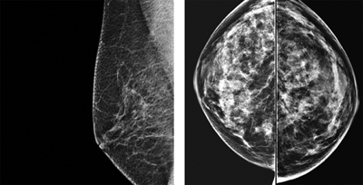 BREAST-DENSITY CHANGES LINKED TO CANCER RISK
