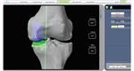 PARTIAL KNEE ARTHROPLASTY: IMPROVING OUTCOMES WITH ROBOTICS