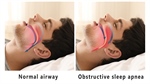 OBSTRUCTIVE SLEEP APNEA: DIAGNOSIS AND TREATMENT