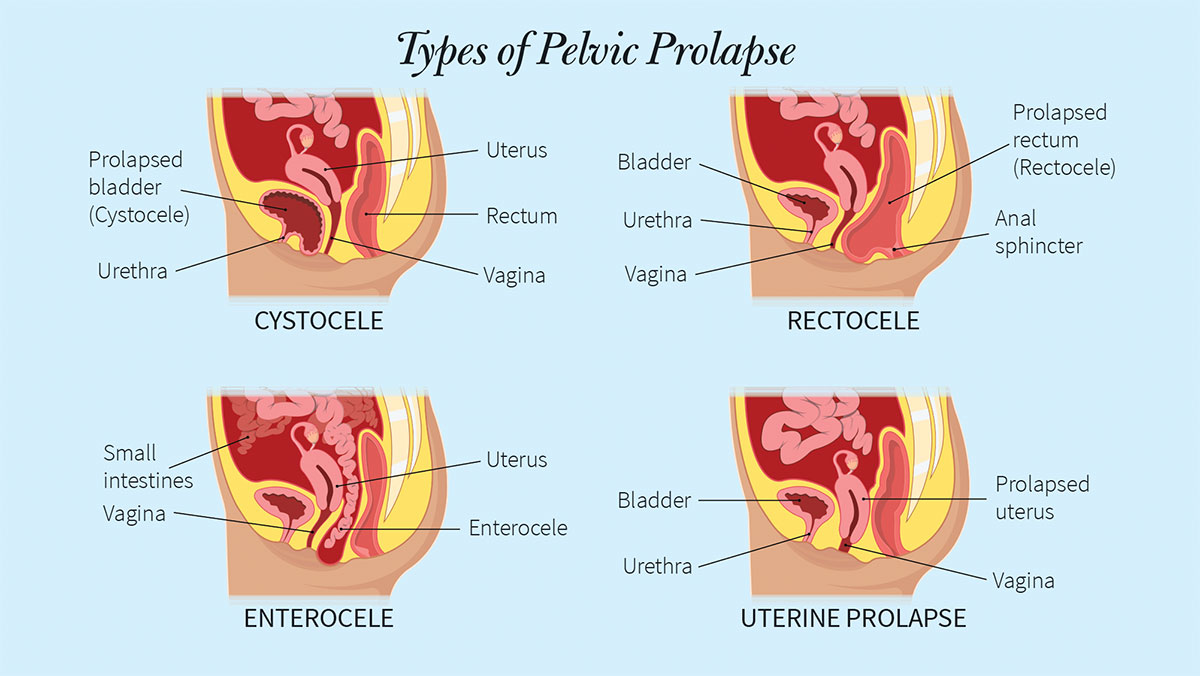 From Silence to Solutions: Treating Pelvic Organ Prolapse - Jennifer Fink