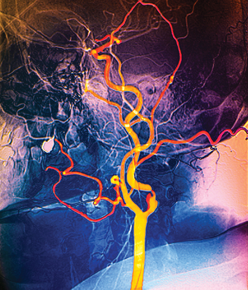 CAROTID ARTERY DISEASE